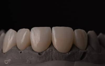 Kako se izrađuju krunice za zube?