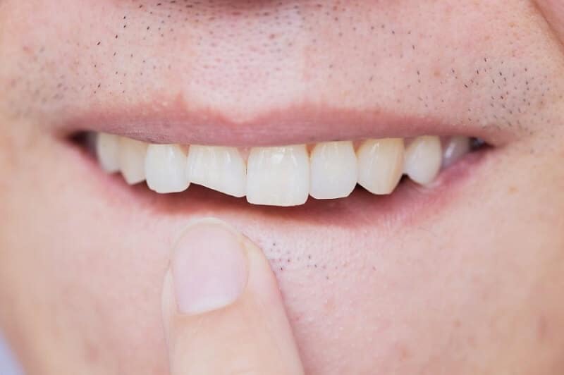 Okrhnut prednji zub