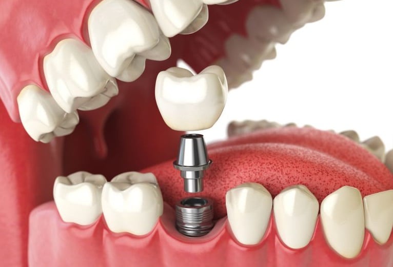 Ilustracija dijelova zubnog implantata