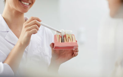 Zubni implantati – Rješenje za izgubljene zube
